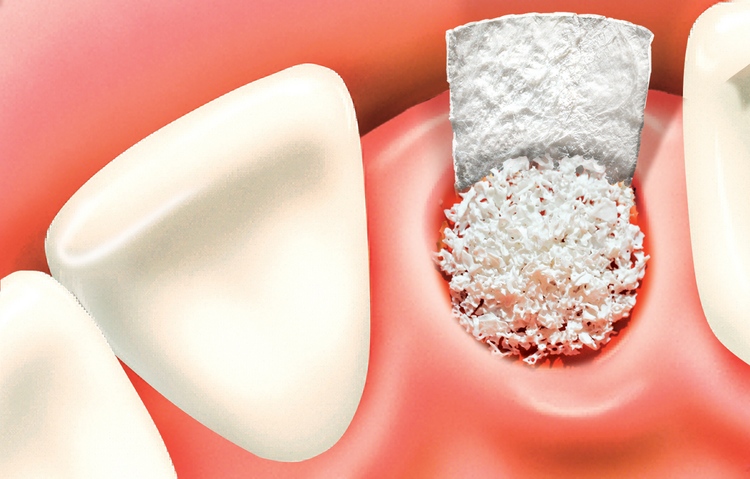 bone graft